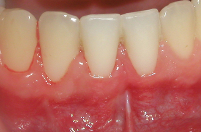 Picture shows the success of a gingival graft.