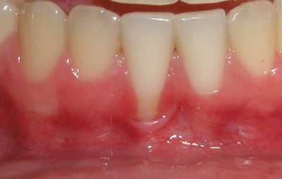 Picture of a mouth that needs a gingival graft