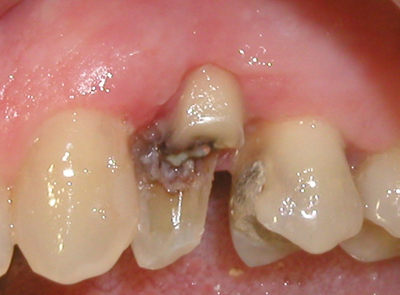 Picture shows results of a pedicle graft treatment.