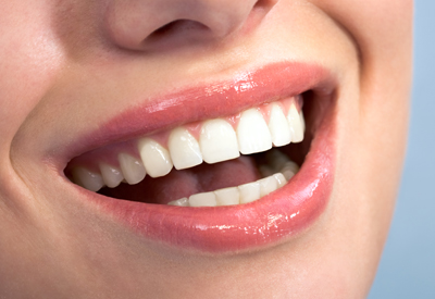 Picture of teeth marked showing where they touch in an unaligned bite. 