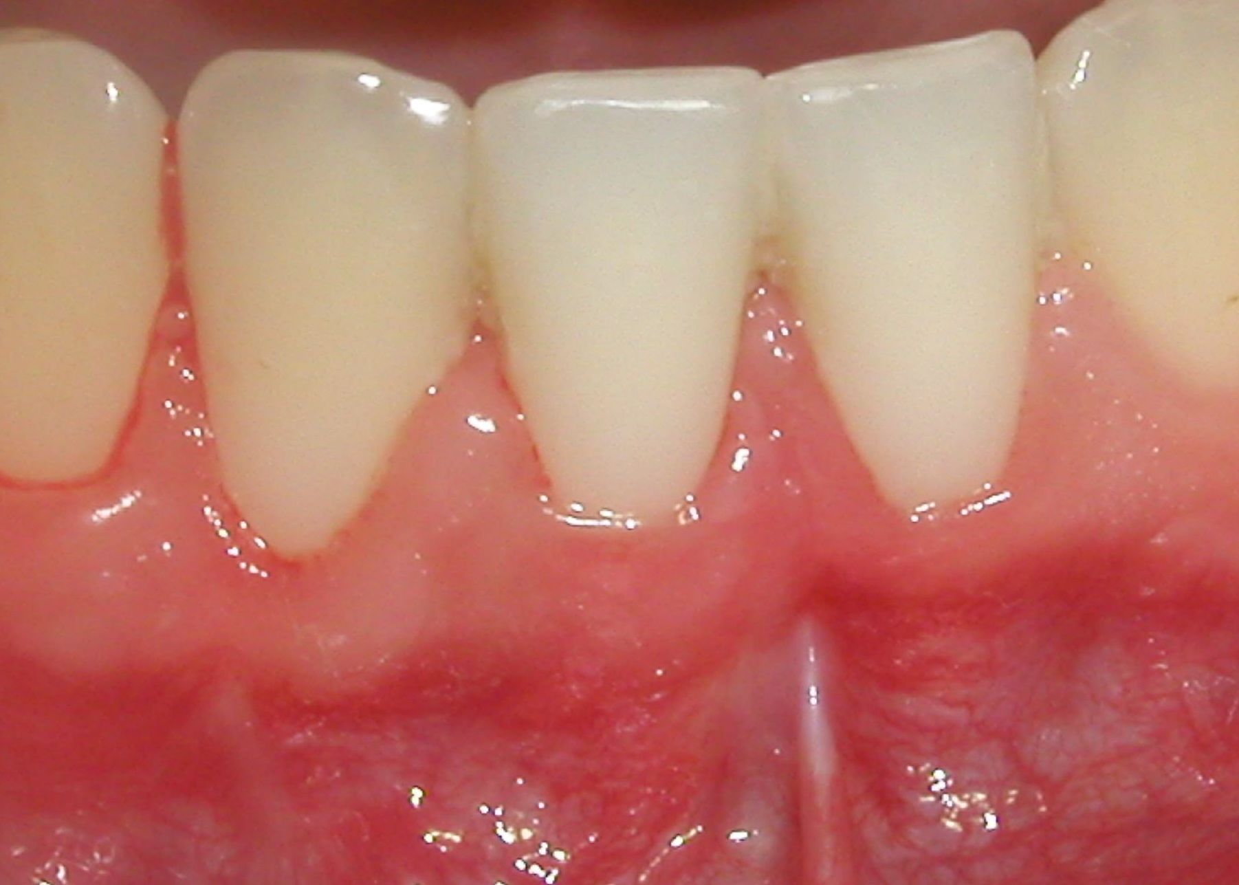 Picture shows results of a pedicle graft treatment.