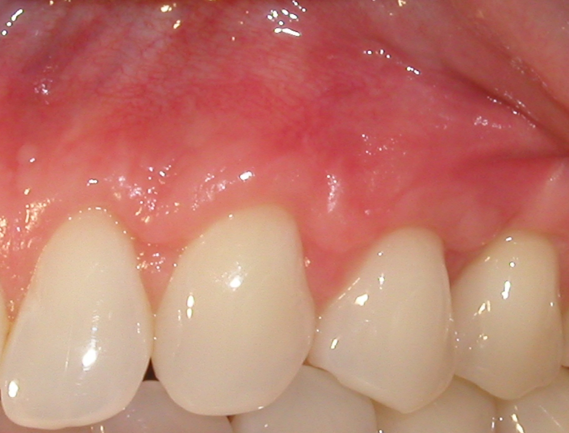 Picture shows the results of a coronal graft.