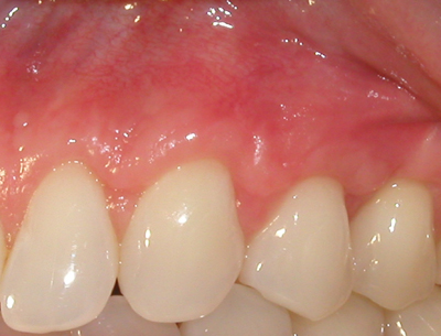 Picture shows the results of a coronal graft.