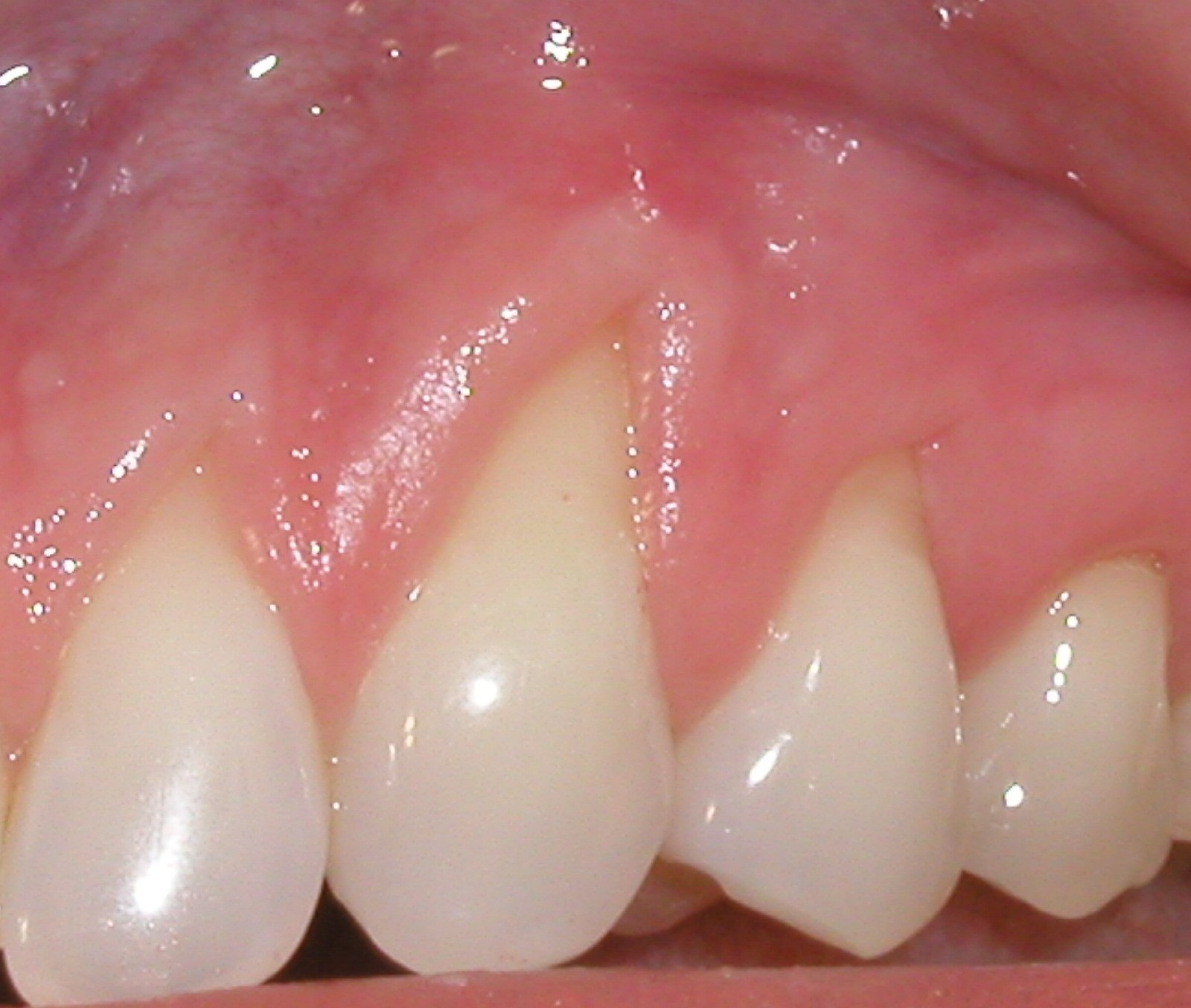 Picture of a mouth that needs a coronal graft