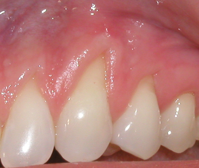 Picture of a mouth that needs a coronal treatment.