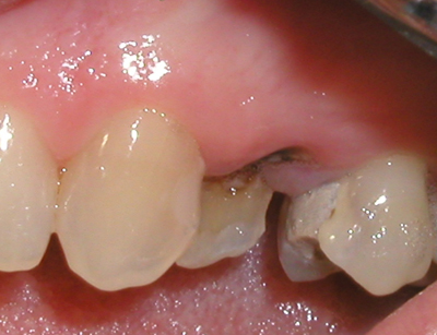 Picture of a mouth in need of pedicle graft treatment.