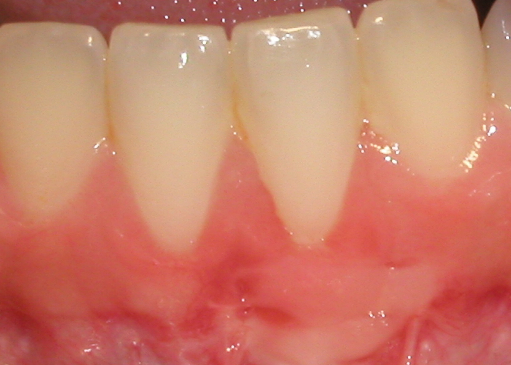 Picture shows the success of a gingival graft.