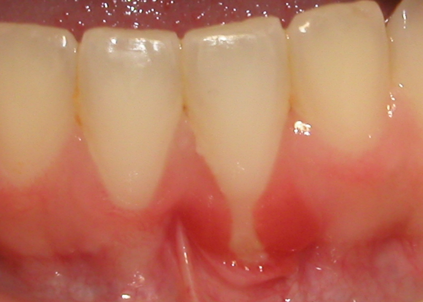Picture shows gingival recession.