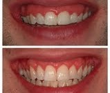 Picture of cosmetic smile enhancement.