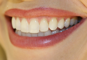 Picture of healthy gums and teeth to demonstrate the difference between bleeding gums and healthy gums.