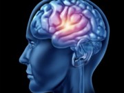 Pic of a human brain that demonstrates a stroke.